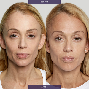 Sculptra (Service)