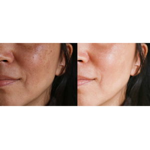Motus AY Laser Treatment - Brown Spots