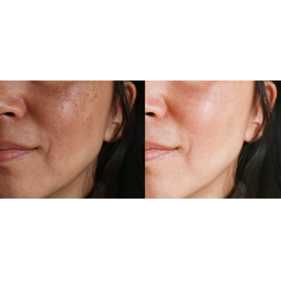 Motus AY Laser Treatment - Brown Spots